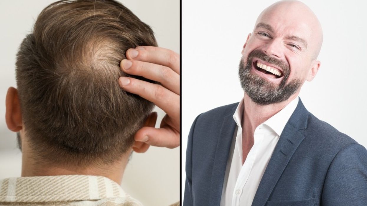 balding, bald people, hair styles, self-confidence, shaving your head