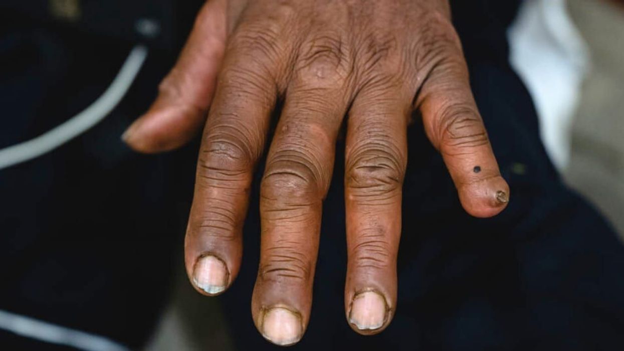 FDA approves medicine that helps treat frostbite and save people from undergoing amputations