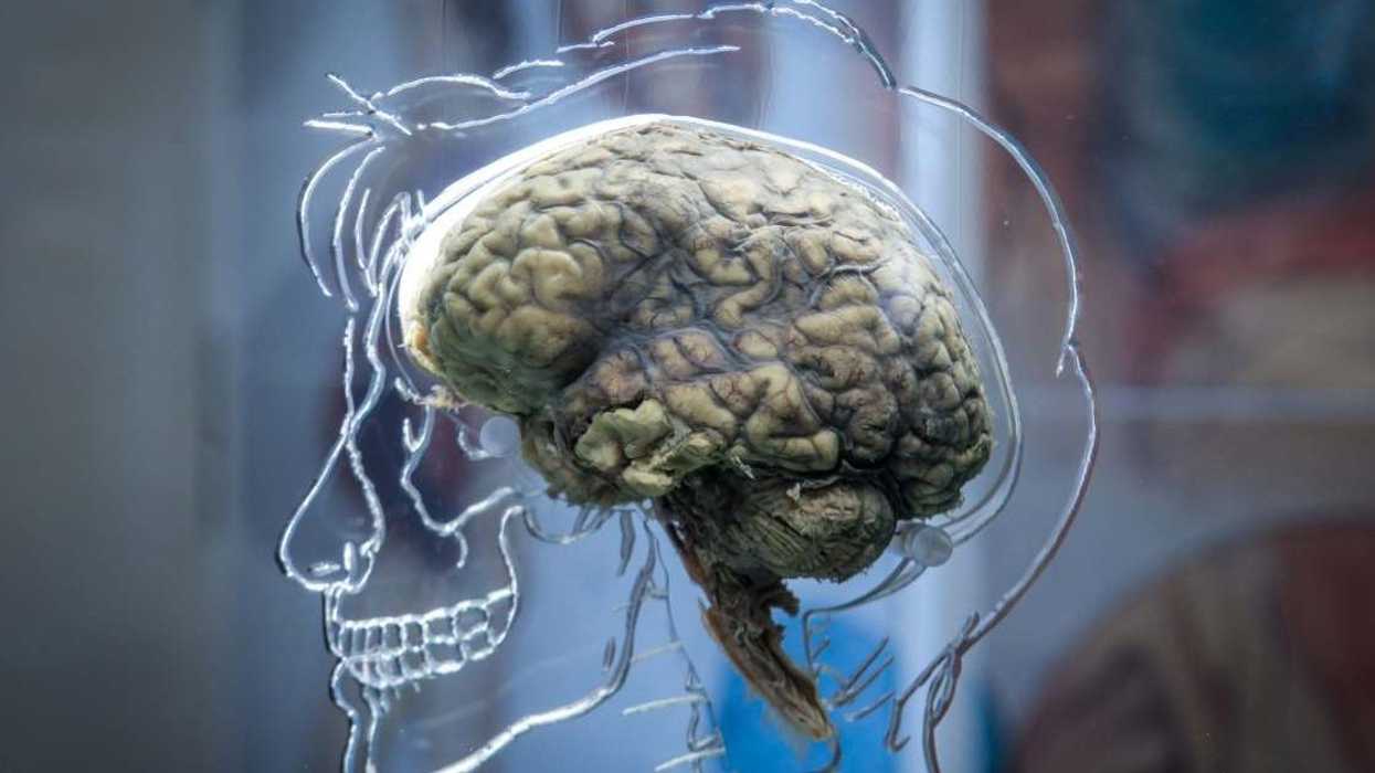 Neuralink’s first user who's quadriplegic reveals what it's like to live with a brain implant chip