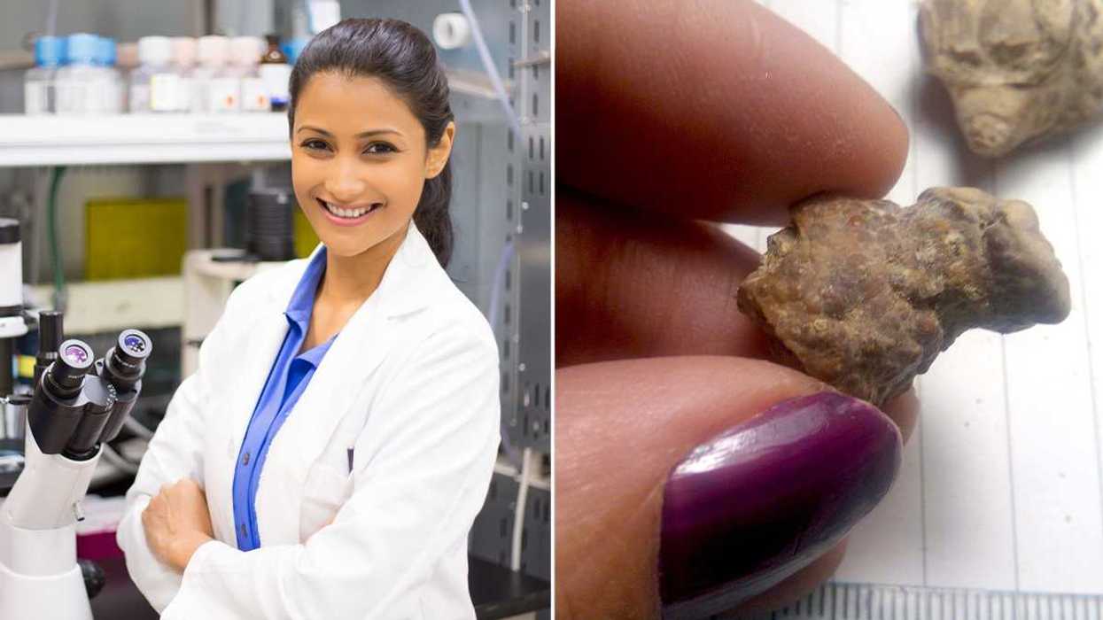 kidney stones, health, Canadian, Waterloo, treatment, less invasive, medical breakthrough, urinary tract