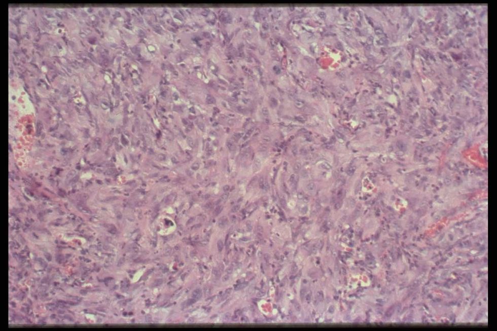 Representative Image Source: Photos of cancerous cells. (Photo by Brooks Kraft LLC/Sygma via Getty Images)