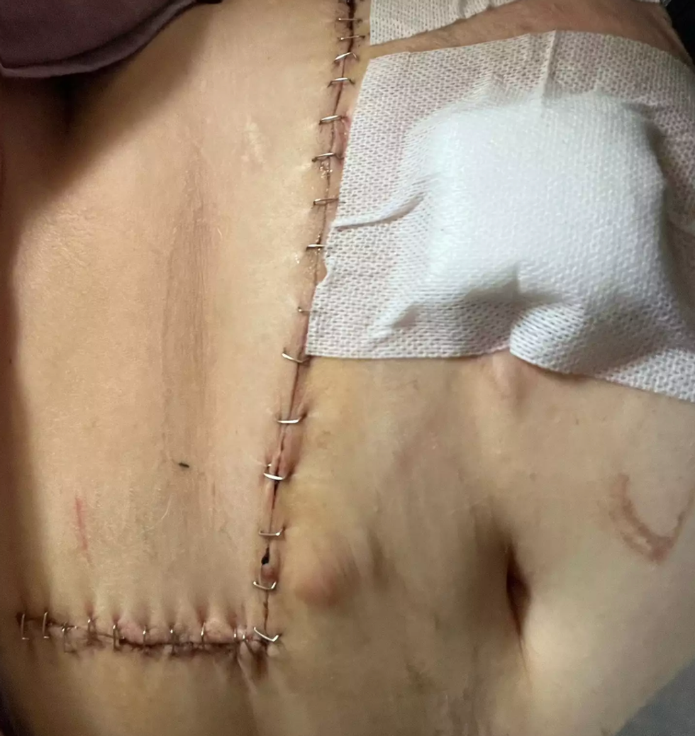 scars, health advocacy, surgery, staples, operation