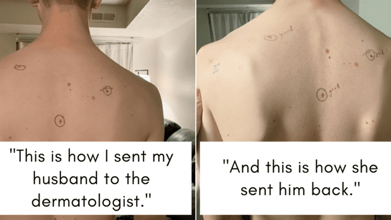 skin checks, melanoma awareness, dermatologist visit, mole mapping, early detection, partner health, TikTok health, viral story, skin cancer signs, biopsy results, preventive care, Utah couple, dermatology tips, patient advocacy, health checklist, mole screening, cancer screening, body mapping, healthcare stories, TikTok dermatology