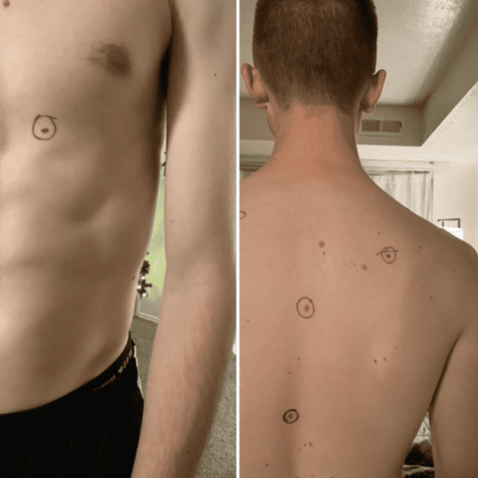 skin checks, melanoma awareness, dermatologist visit, mole mapping, early detection, partner health, TikTok health, viral story, skin cancer signs, biopsy results, preventive care, Utah couple, dermatology tips, patient advocacy, health checklist, mole screening, cancer screening, body mapping, healthcare stories, TikTok dermatology