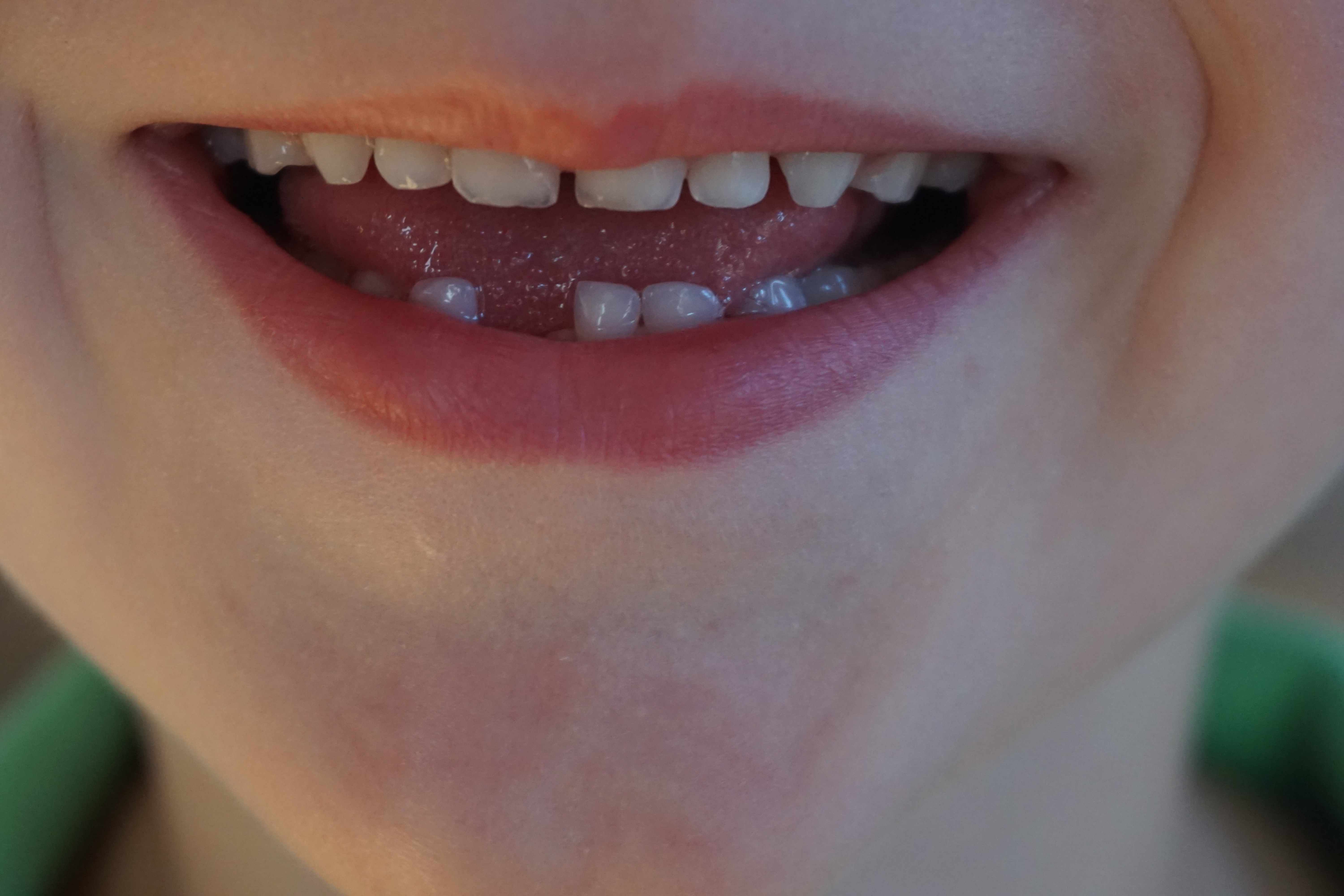 closeup of a child's smile missing teeth