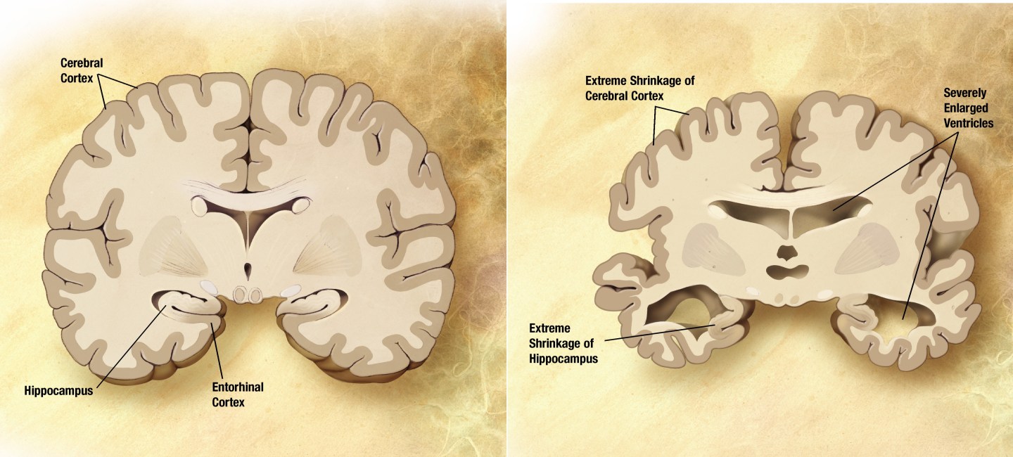 brain, alzheimers, disease, research, science