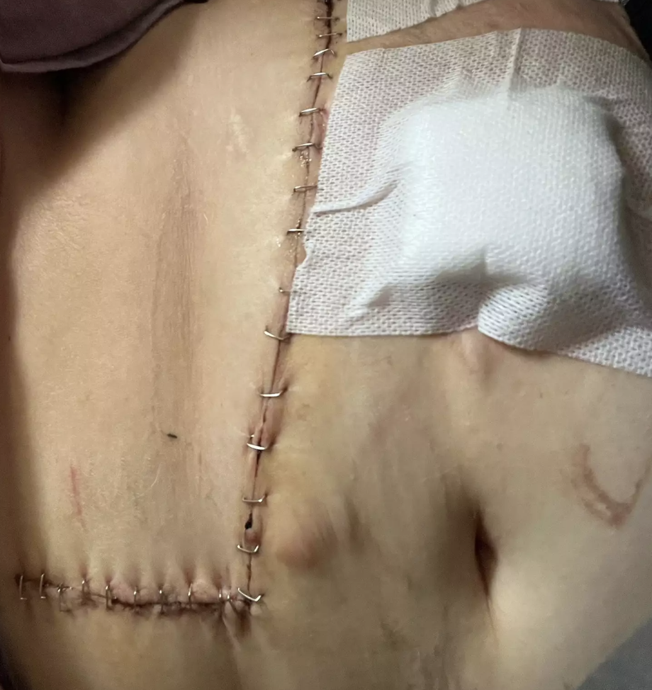 scars, health advocacy, surgery, staples, operation
