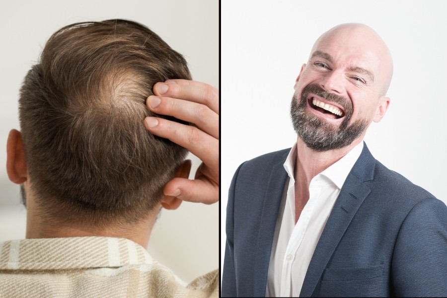 balding, bald people, hair styles, self-confidence, shaving your head