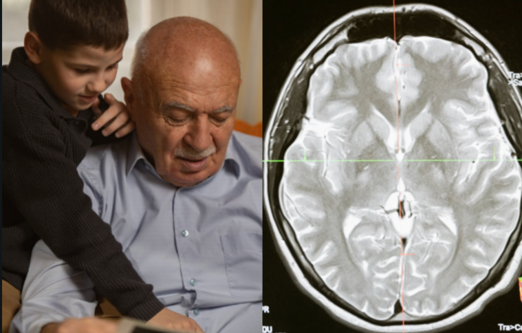 brain age, neuroscience, dementia, cognitive, scientific discovery