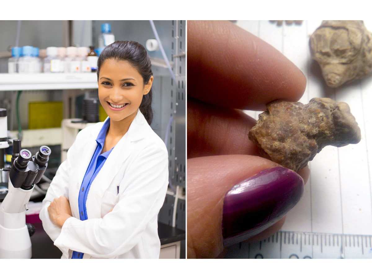 Canadian scientists create magnetic robots that can dissolve kidney stones in days