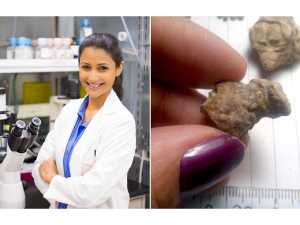kidney stones, health, Canadian, Waterloo, treatment, less invasive, medical breakthrough, urinary tract