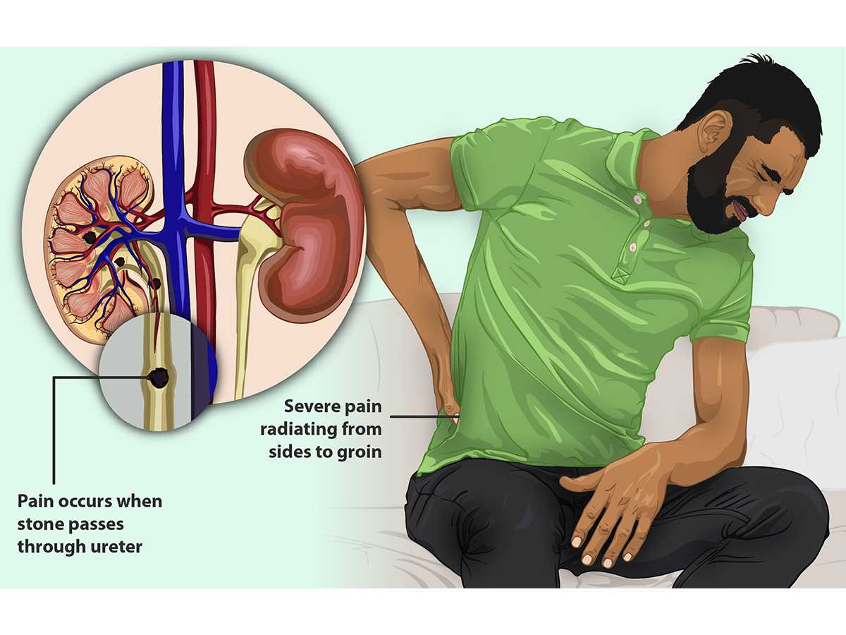 healthcare, surgery, stone dissolution, groin, pain radiation, graphics, non-surgical, medicine distribution
