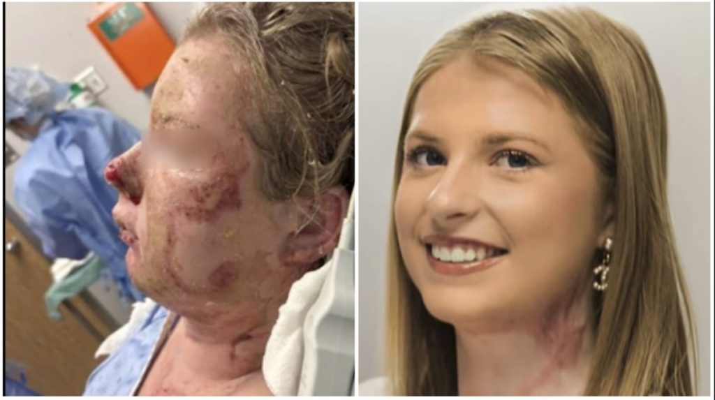 Student with severe facial burns from a frat house fire healed through new innovative treatment