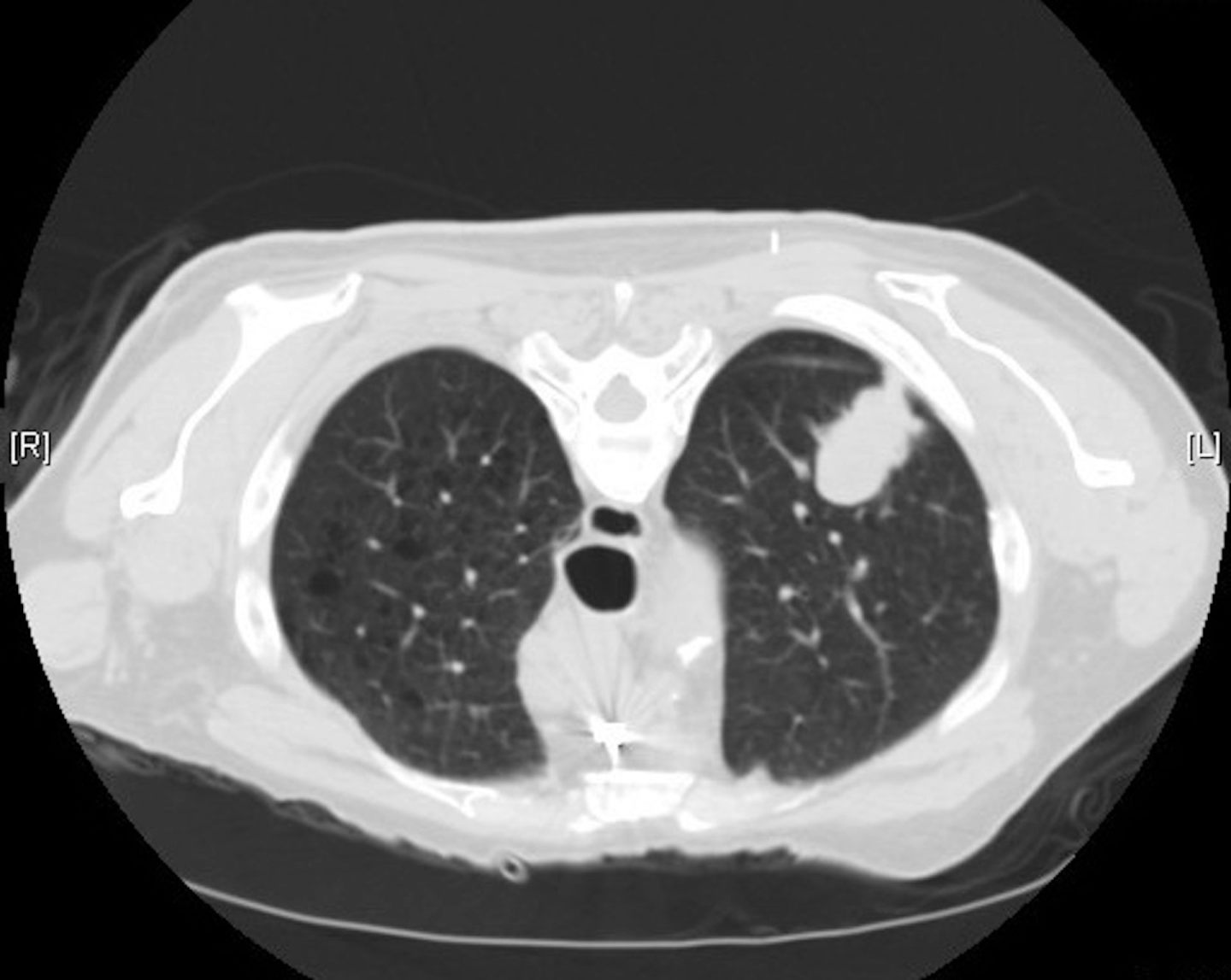 Pope Leo XIV’s lung cancer highlights growing number of nonsmokers diagnosed with the disease – and younger people too